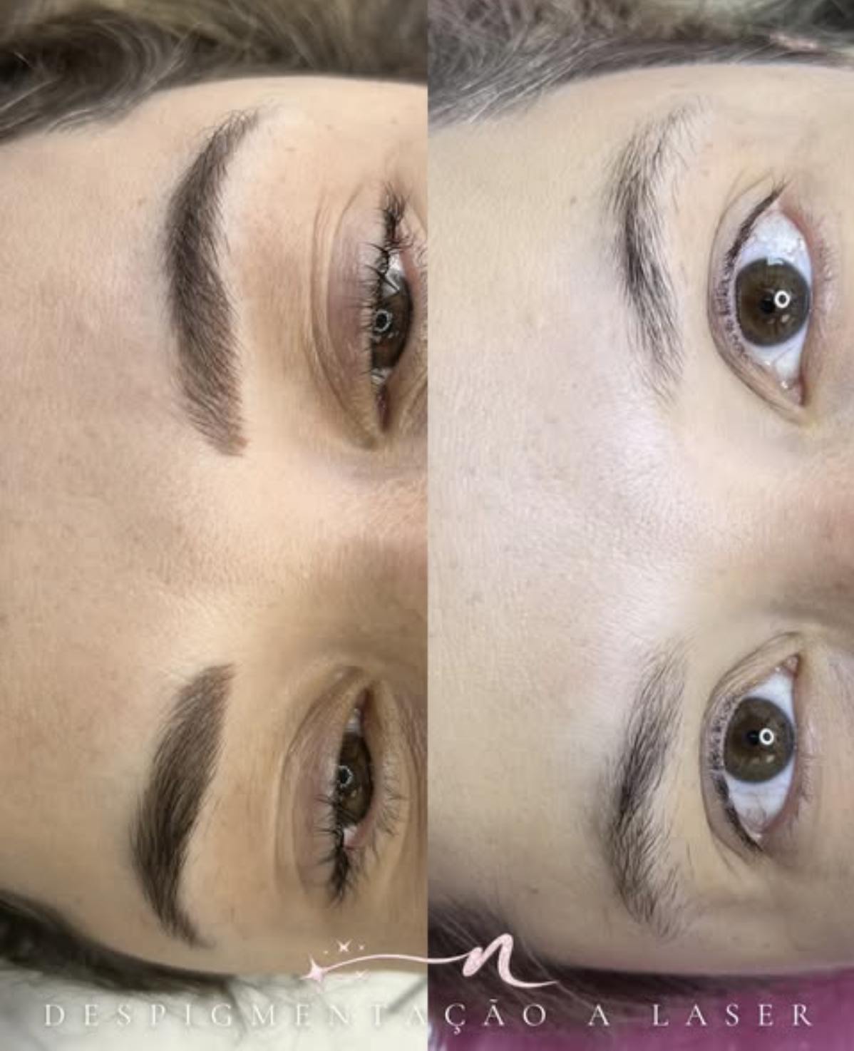 Resultado remoção micropigmentação sobrancelha